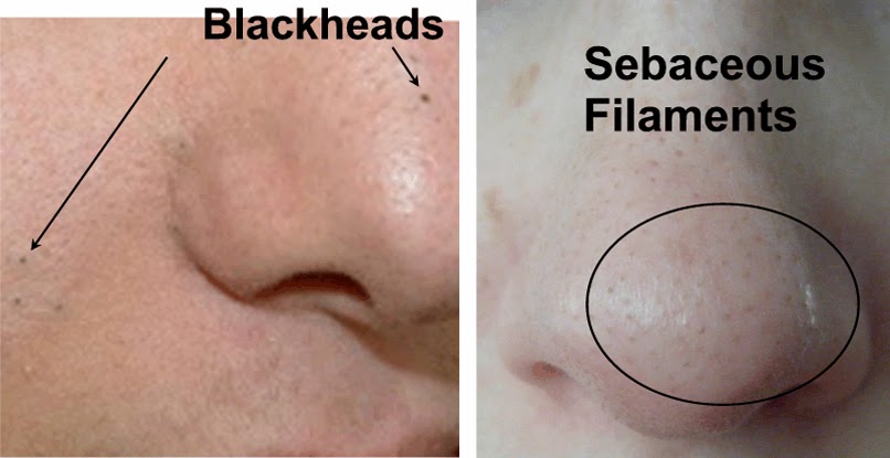 The Truth about Blackheads (+how to actually get rid of them!) – Amalie