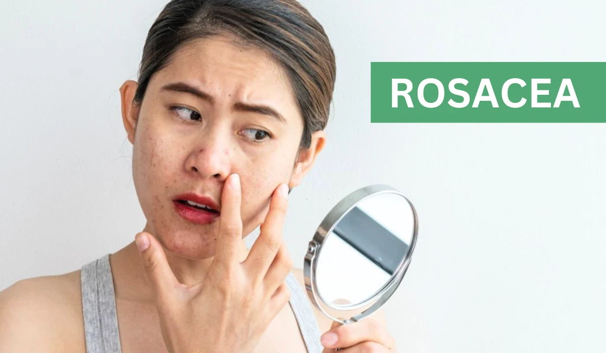 How To Get Rid Of Rosacea Acne