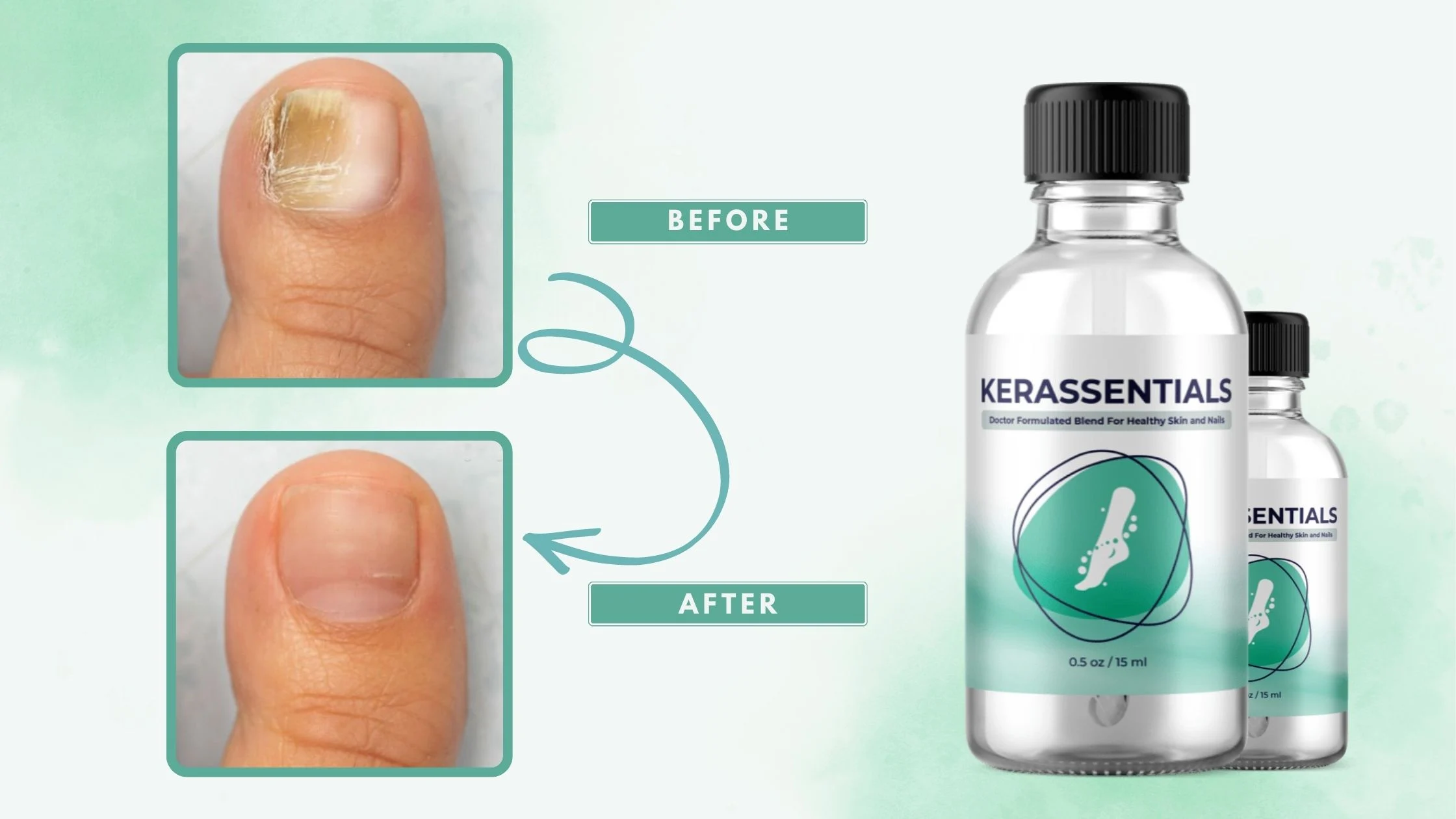 Kerassentials before and after