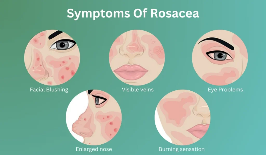 Symptoms of Rosacea Acne
