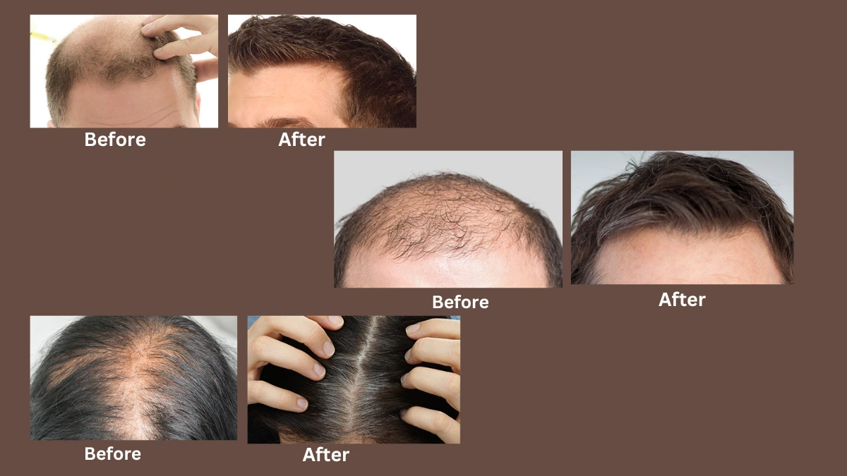 Hair Revital X before and after