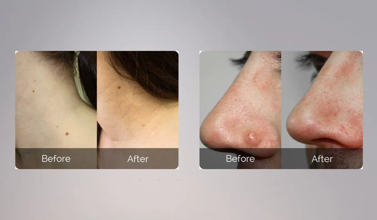 SkinBiotix MD Skin Tag Remover Before And After
