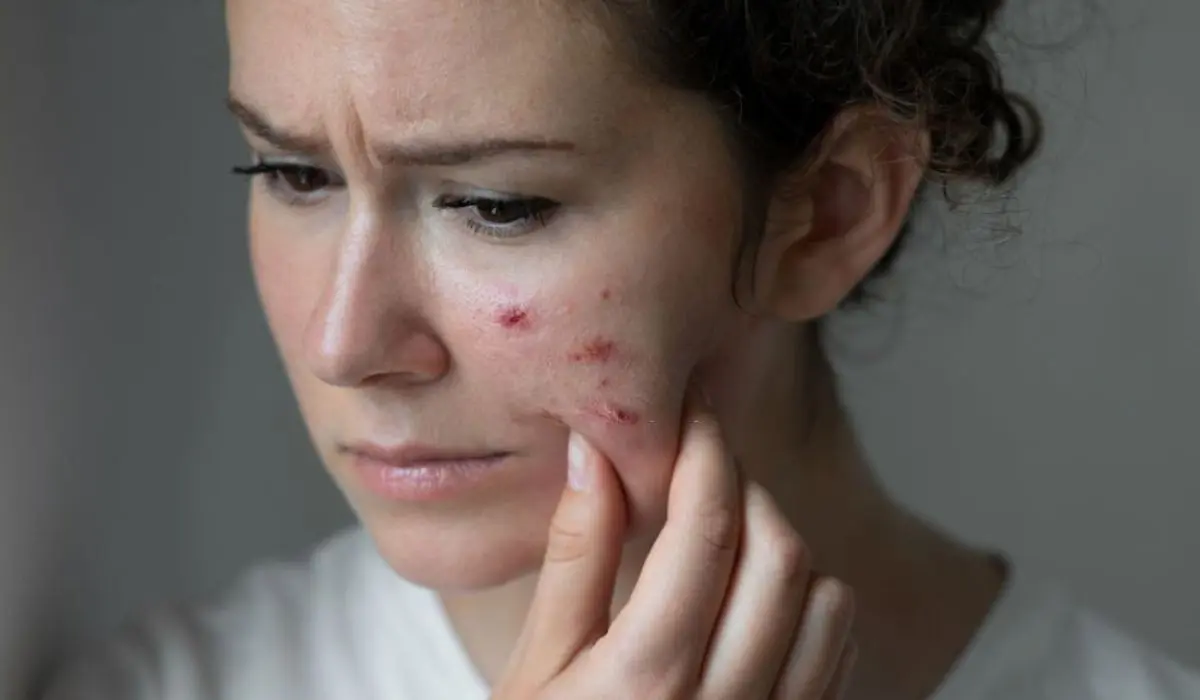 Understanding The Role Of Gut Health In Acne
