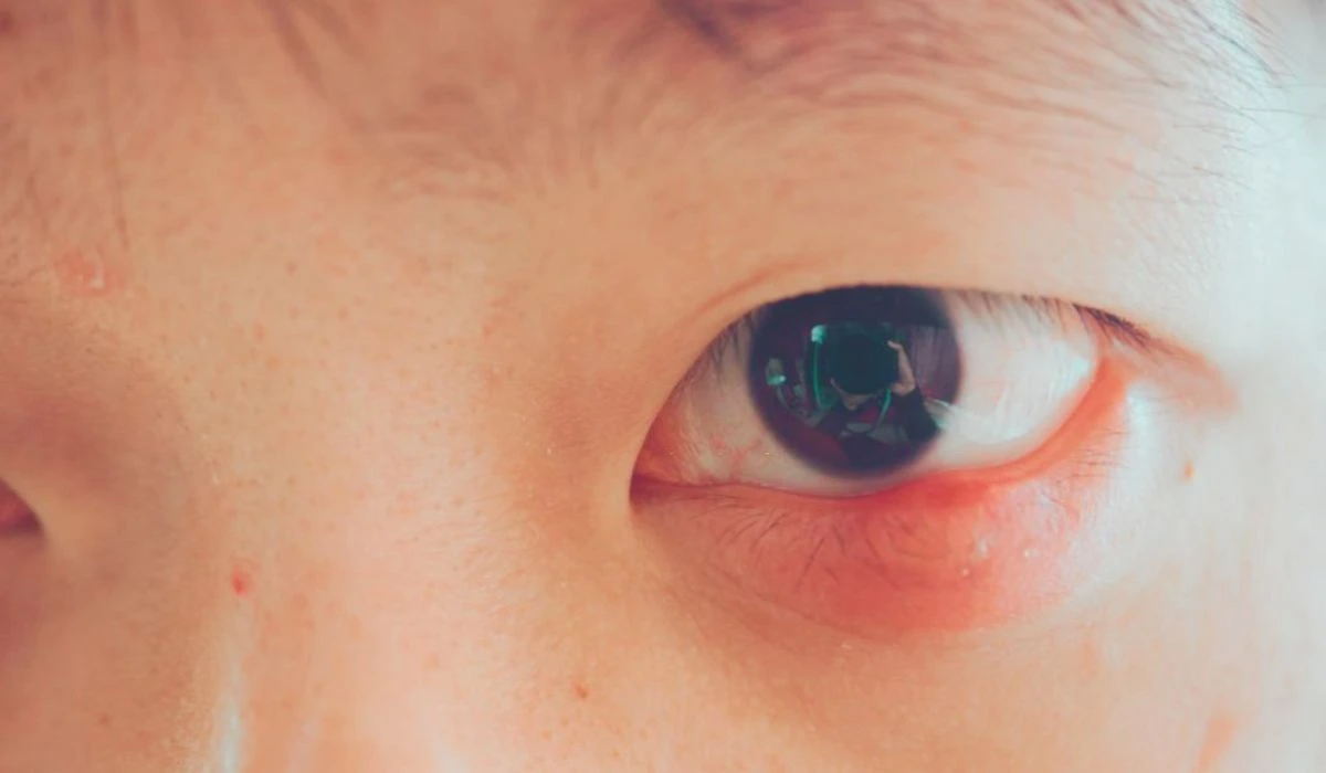 Causes Of Eye Styes