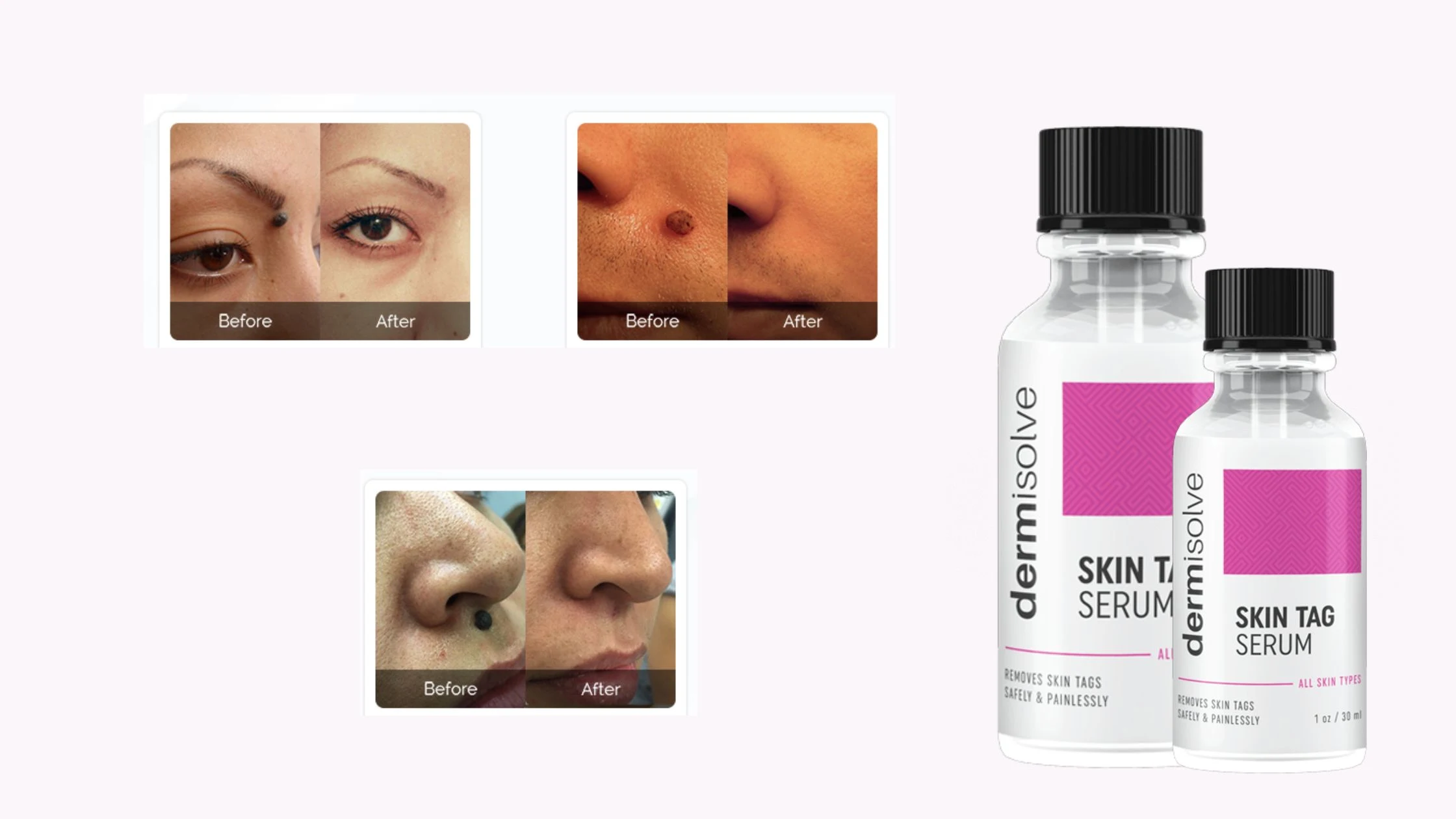 Dermisolve Skin Tag Remover Before And After