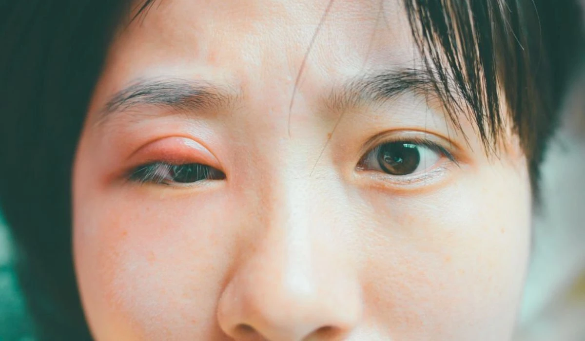 What Causes Eye Styes How To Treat Them Effectively